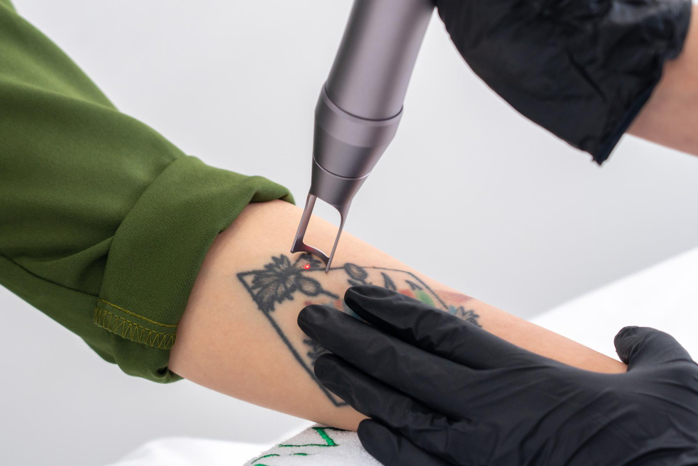 Unwanted Tattoos